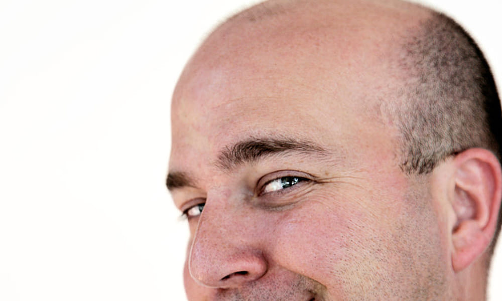 Scientists have discovered TGF-beta  that may lead to the effective treatment of baldness