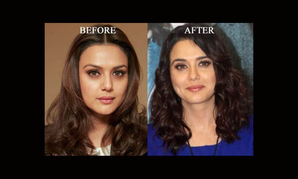 Plastic Surgery Disasters of Bollywood Celebrities