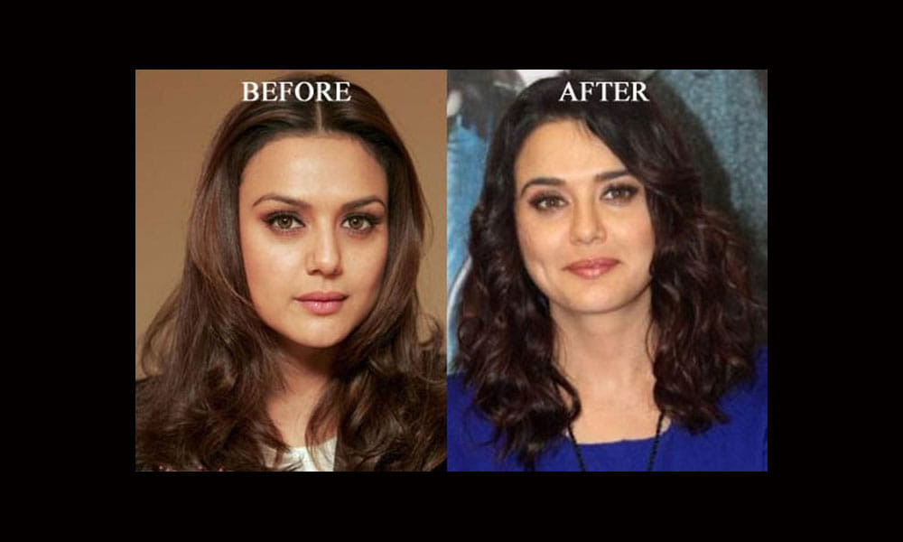 Plastic Surgery Disasters of Bollywood Celebrities