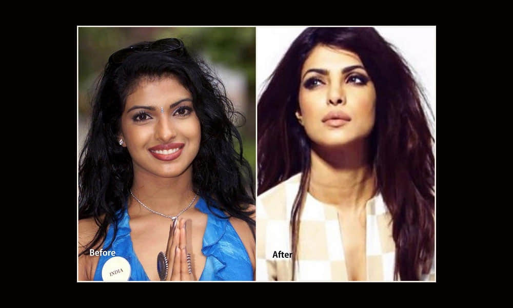 Plastic Surgery Disasters of Bollywood Celebrities