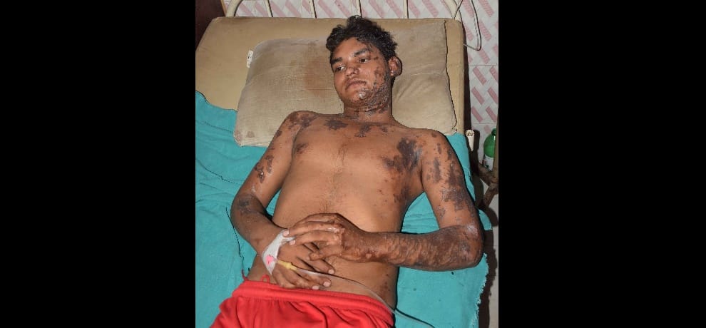 in a road rage canter driver throws acid on six including woman in noida's chotpur village