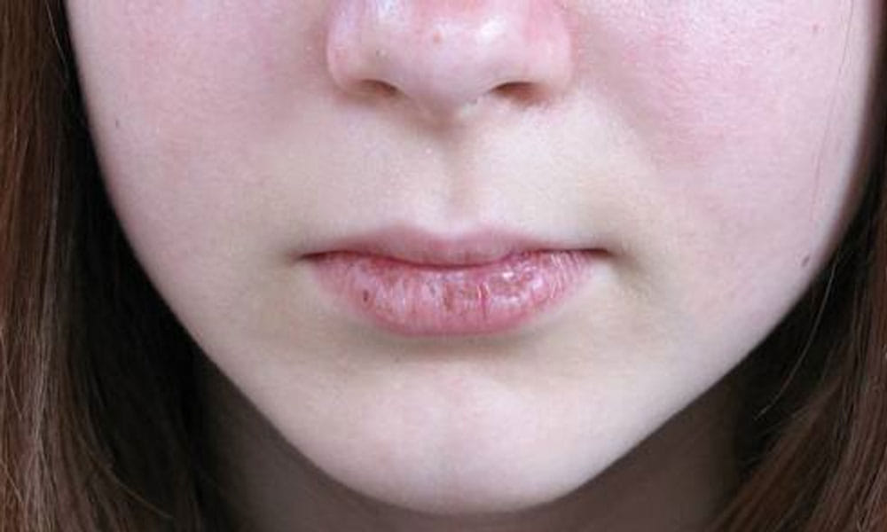 Infection On Lips In Hindi