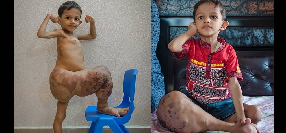 Akshaj Khandelwal from Delhi, suffers from Klipper-Trenaunay Syndrome 