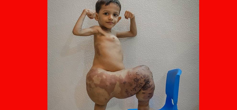 Akshaj Khandelwal from Delhi, suffers from Klipper-Trenaunay Syndrome 