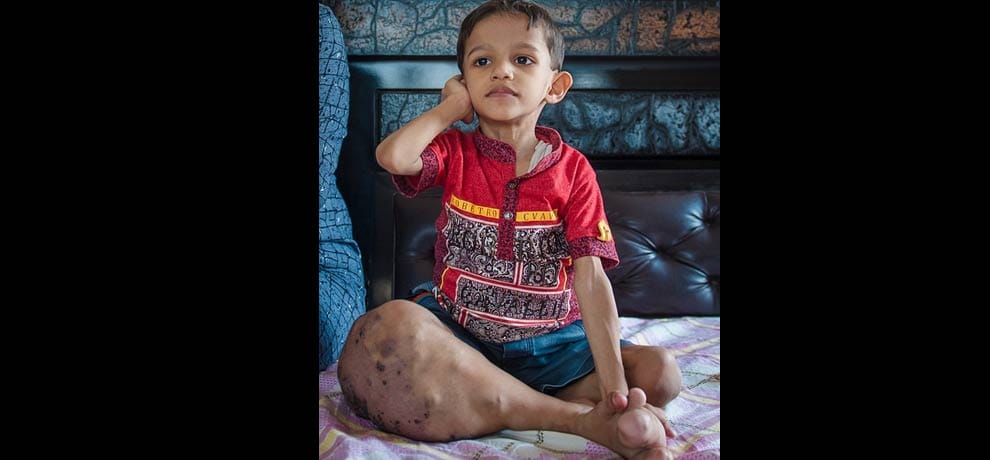 Akshaj Khandelwal from Delhi, suffers from Klipper-Trenaunay Syndrome 