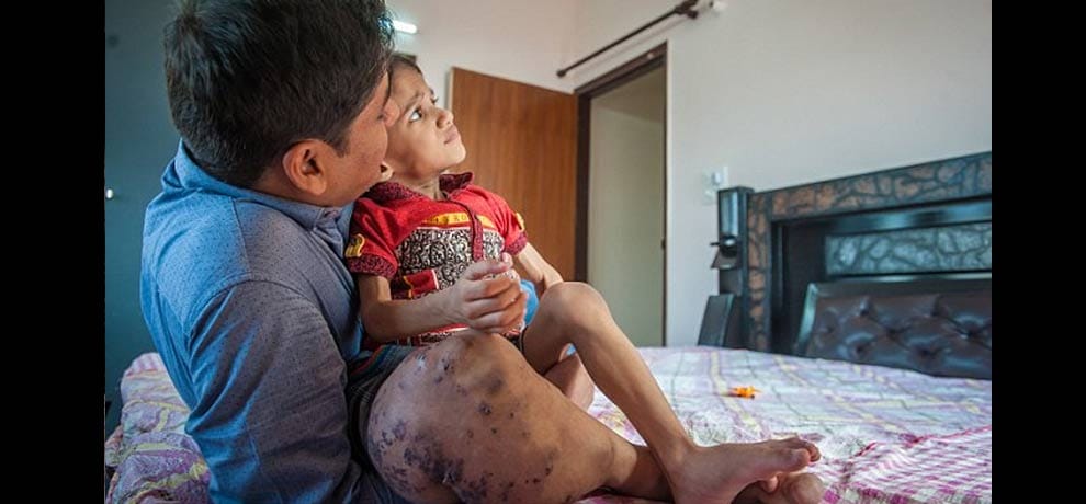 Akshaj Khandelwal from Delhi, suffers from Klipper-Trenaunay Syndrome 