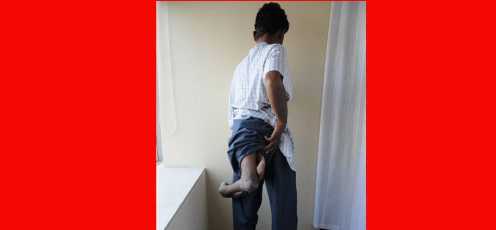 man with four limbs goes viral on social media when asked for help, delhi hospital came forward