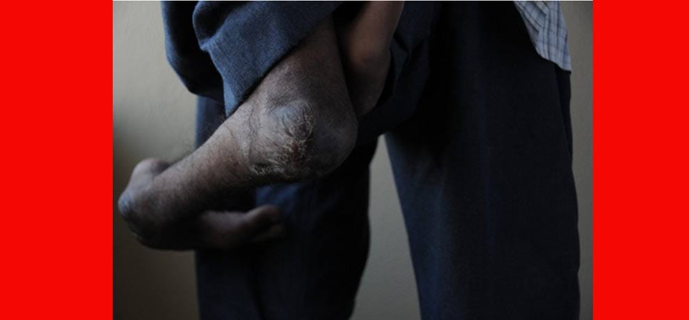 man with four limbs goes viral on social media when asked for help, delhi hospital came forward