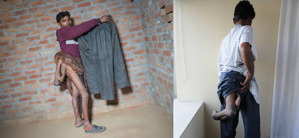 man with four limbs goes viral on social media when asked for help, delhi hospital came forward