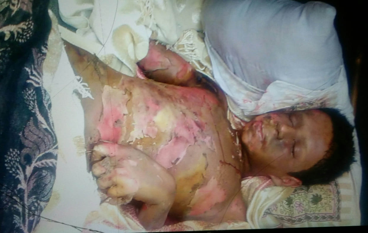 IX student of scorching high tension wires to be vulnerable, serious