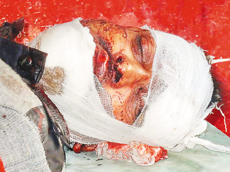 Former pradhan and bike rider injured in accident