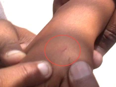 White Snake Bite Manisha for 26th Time.