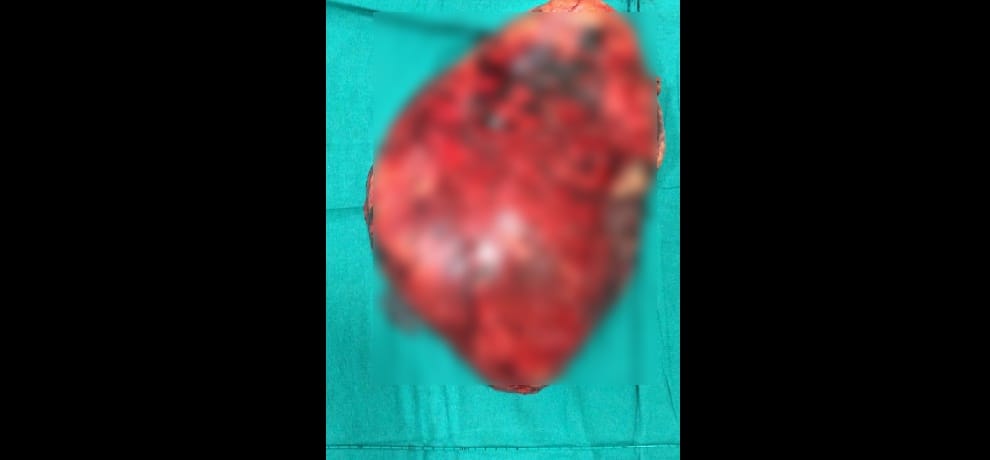 7 kg tumor operated from kidney