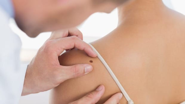 mole on body meaning money problem