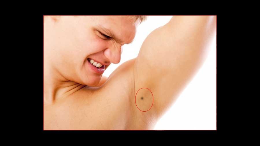 body mole meaning and importance