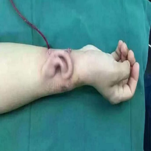 Doctor grows new ear on a man's ARM 