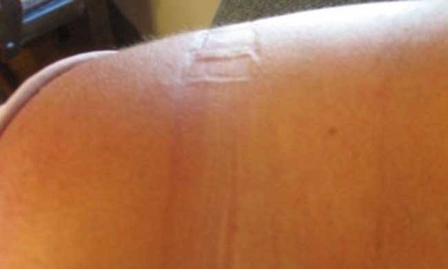 home remedies to remove bra marks 