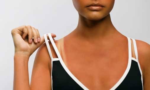 home remedies to remove bra marks 