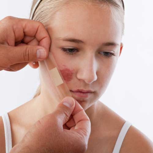 Harmful Effect Of Love Bites