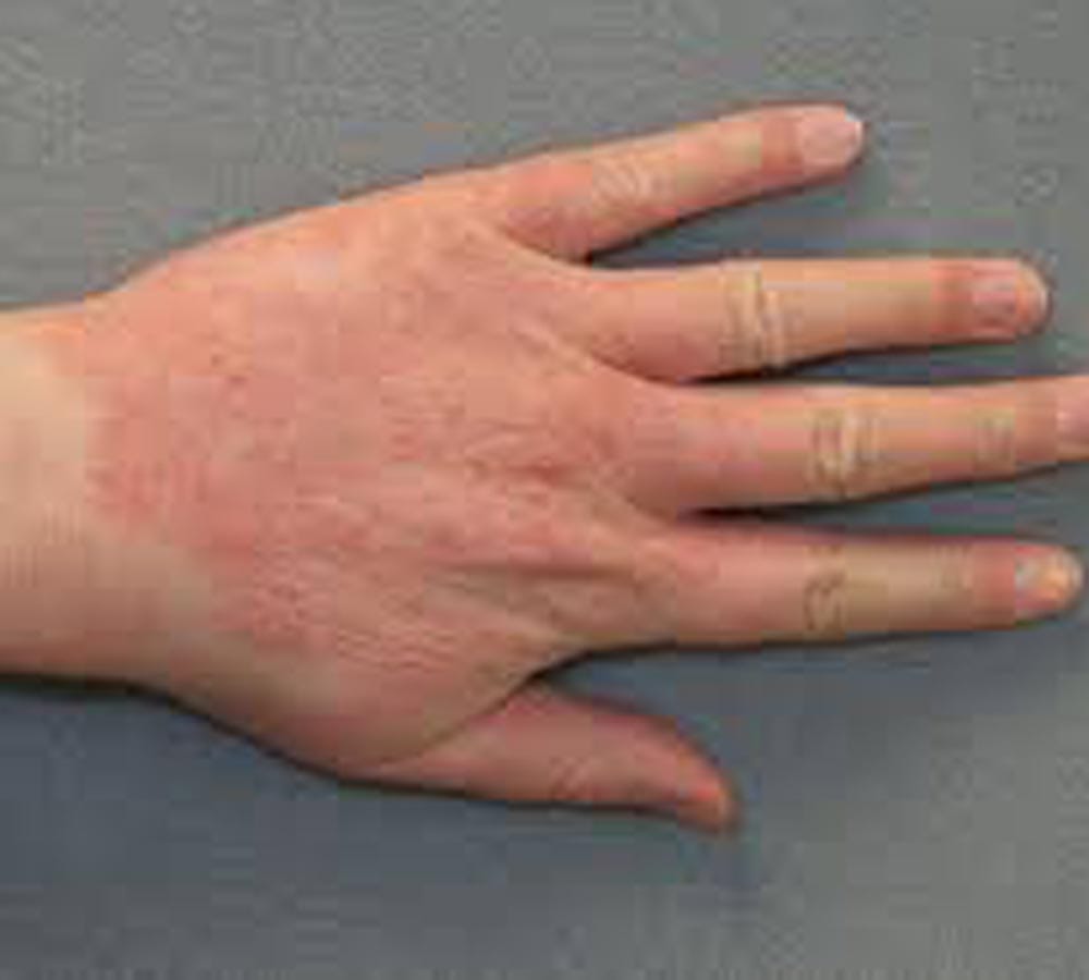  say bye bye to itching problem