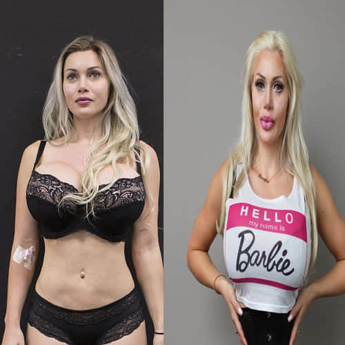 Model who has undergone more than 100 cosmetic procedures