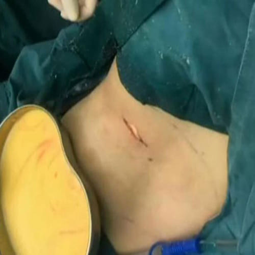 Woman grows breasts on her belly