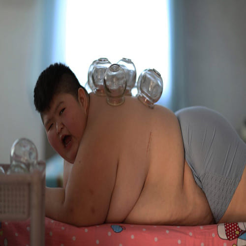  11 year old set on FIRE and undergoes cupping treatment