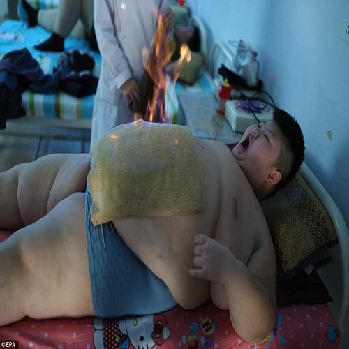  11 year old set on FIRE and undergoes cupping treatment