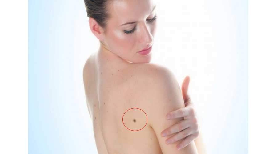 mole on these body parts is lucky for you