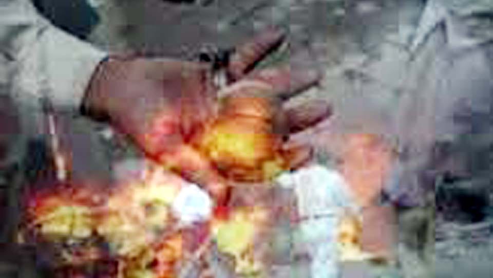 xplosion in garbage two children badly scorched