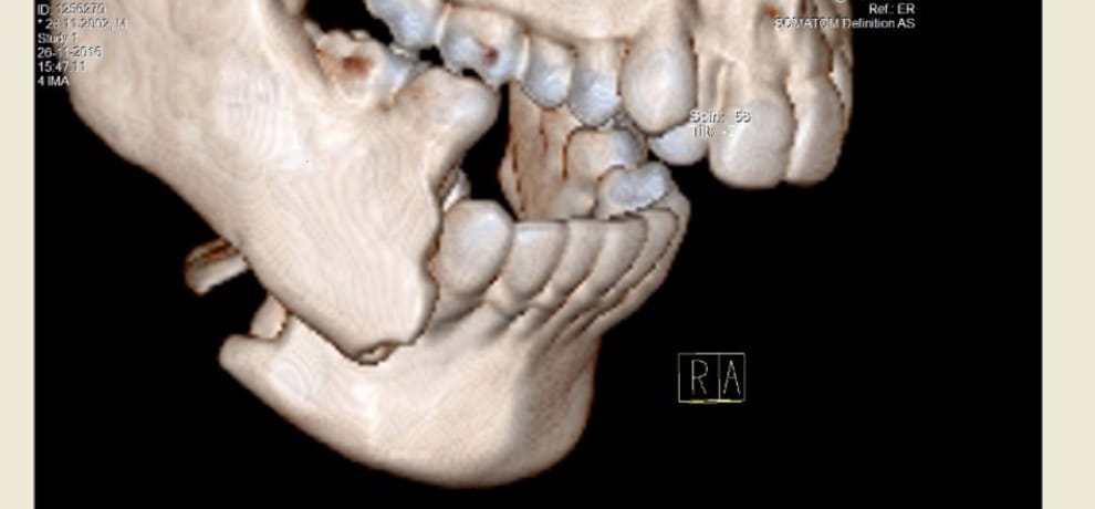 Jawbone broken in two parts
