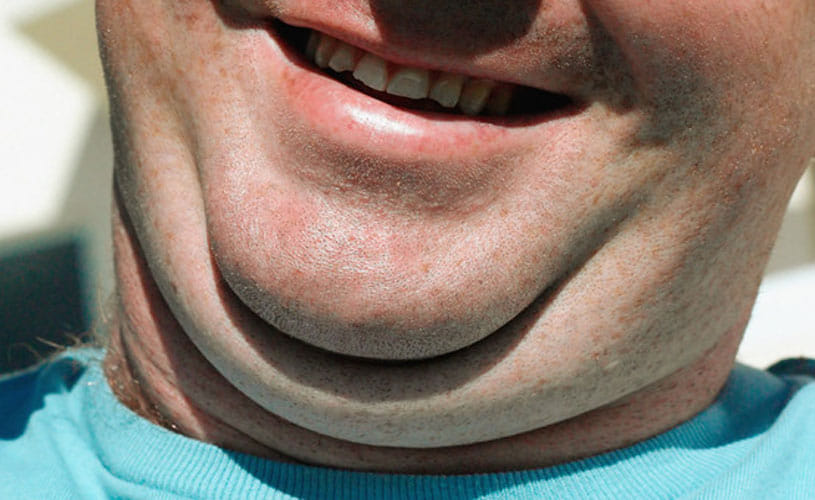 Exercises For Facial Fat