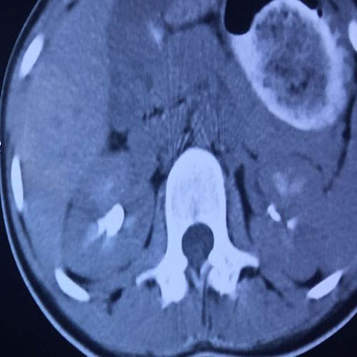 Giant hairball weighing 3kg removed from stomach of 14-year-old girl 