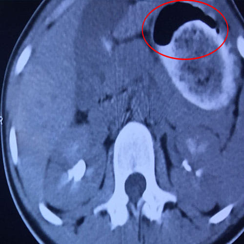 Giant hairball weighing 3kg removed from stomach of 14-year-old girl 