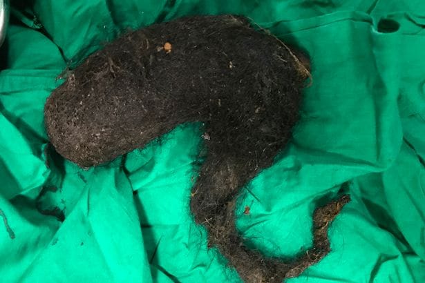 Giant hairball weighing 3kg removed from stomach of 14-year-old girl 