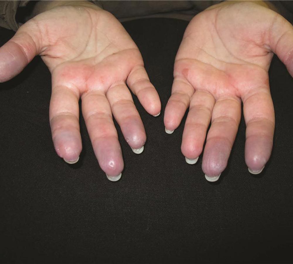 get rid of swollen fingers in winters