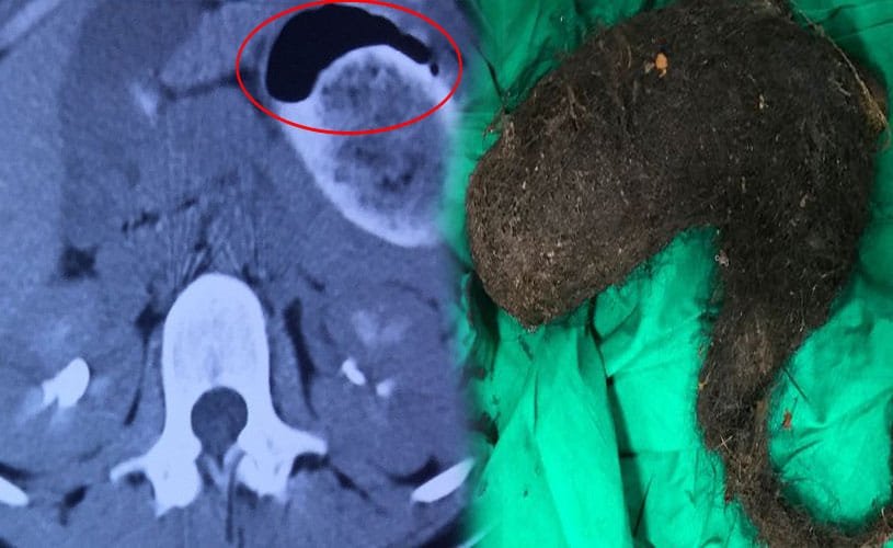 Giant hairball weighing 3kg removed from stomach of 14-year-old girl 