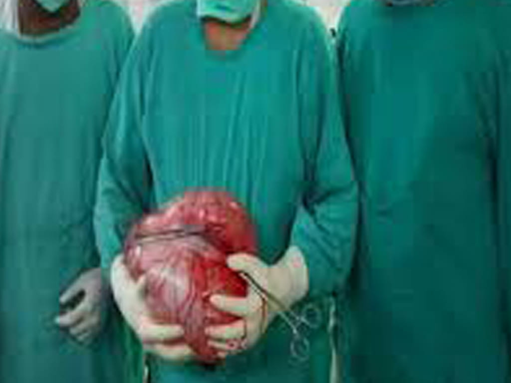2.5 kilogram tumor removed from teenager stomach