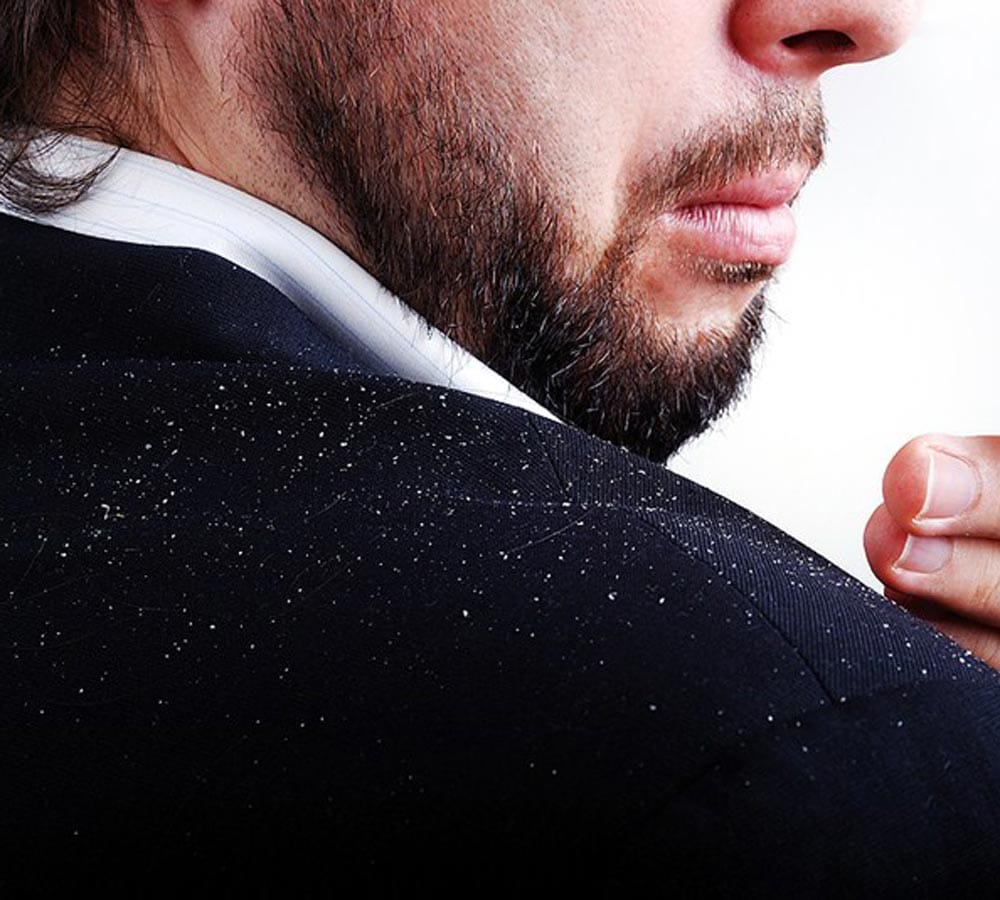 get rid of dandruff naturally