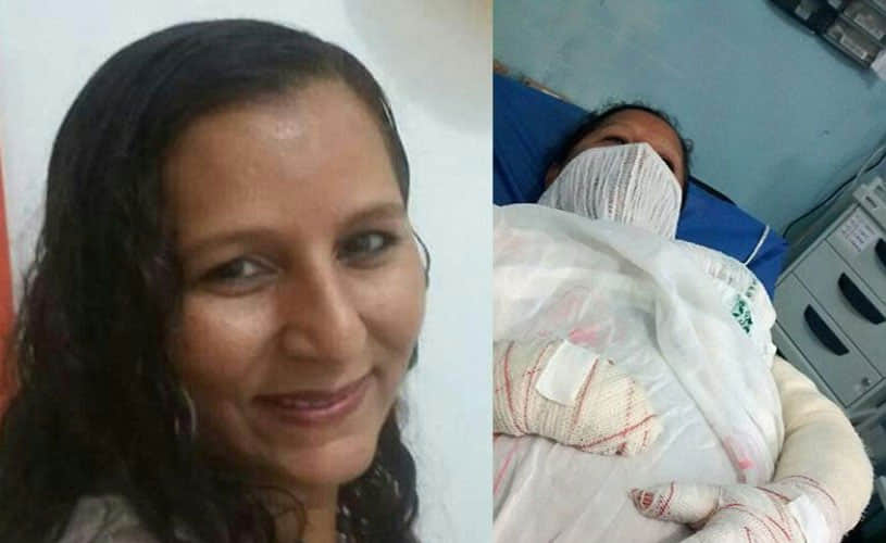 Doctors Use Fish Scales To Treat Woman’s Burned Body And The Result Is Amazing