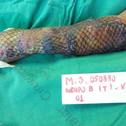 Doctors Use Fish Scales To Treat Woman’s Burned Body And The Result Is Amazing