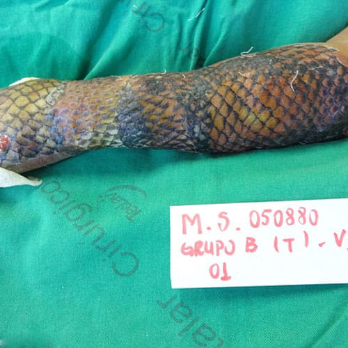 Doctors Use Fish Scales To Treat Woman’s Burned Body And The Result Is Amazing