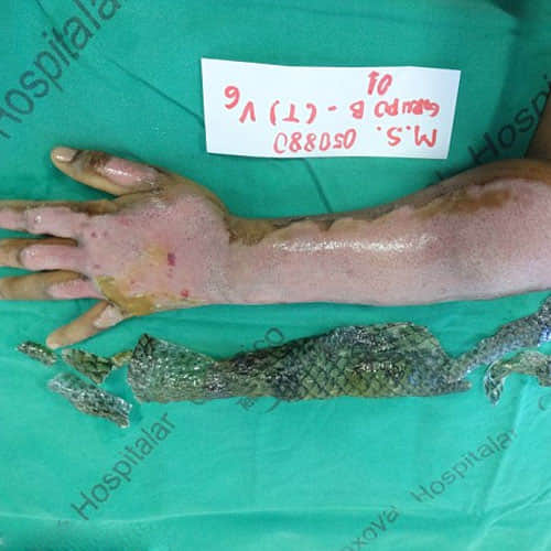 Doctors Use Fish Scales To Treat Woman’s Burned Body And The Result Is Amazing