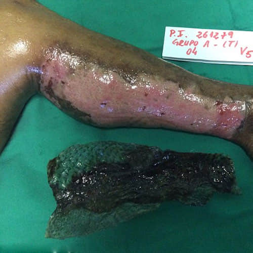Doctors Use Fish Scales To Treat Woman’s Burned Body And The Result Is Amazing