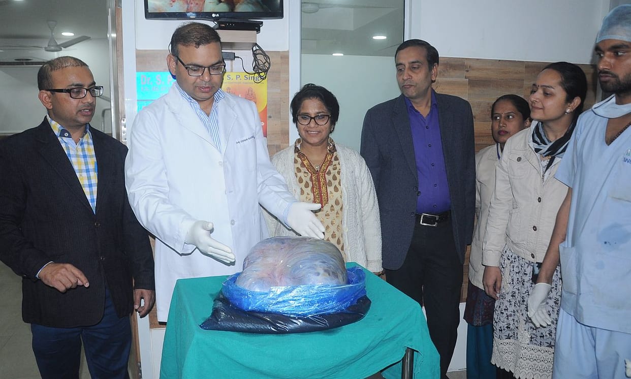 17 kg tumor removed surgery