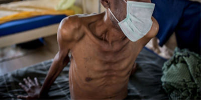 TB remains a serious problem in the district, five deaths every month