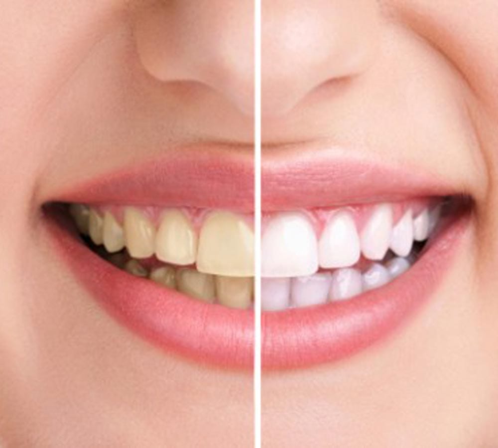 get rid of yellow teeth at home easily