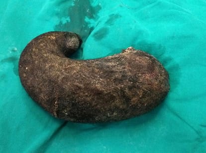 rare surgery of 15 years old girl surgery at ludhiana, bunch of hairs come out, doctors amazed