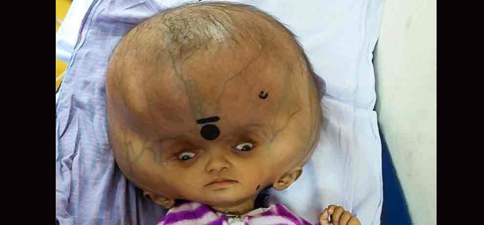 7 month old baby called ghost because he was having worlds largest head after disease 