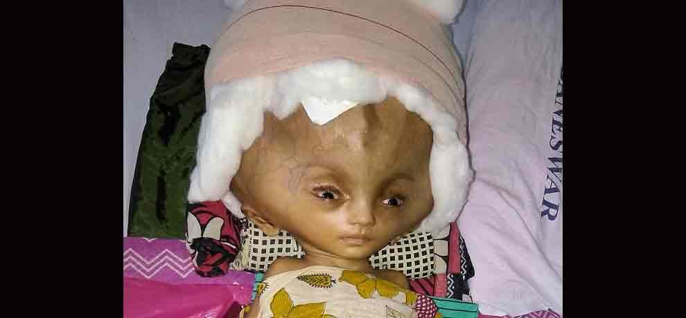 7 month old baby called ghost because he was having worlds largest head after disease 